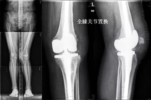 想做膝关节置换？那下面这些您要了解下！