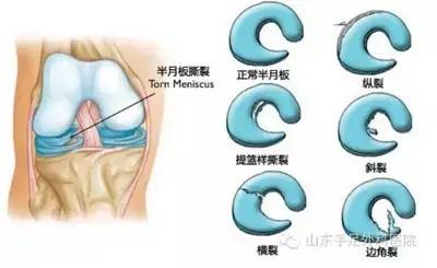 你的关节是否“咔咔”作响?