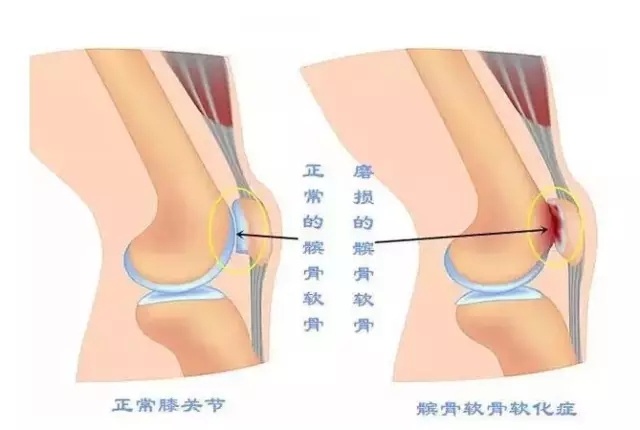 哪些病会引起膝关节炎？膝关节滑膜炎锻炼方法！