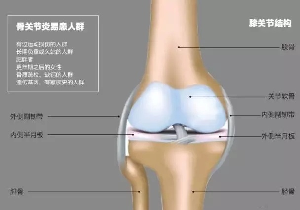 膝关节炎六大认识误区