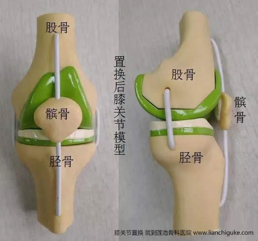 膝关节置换手术流程