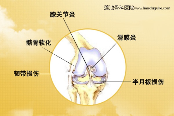 膝关节日常生活注意事项