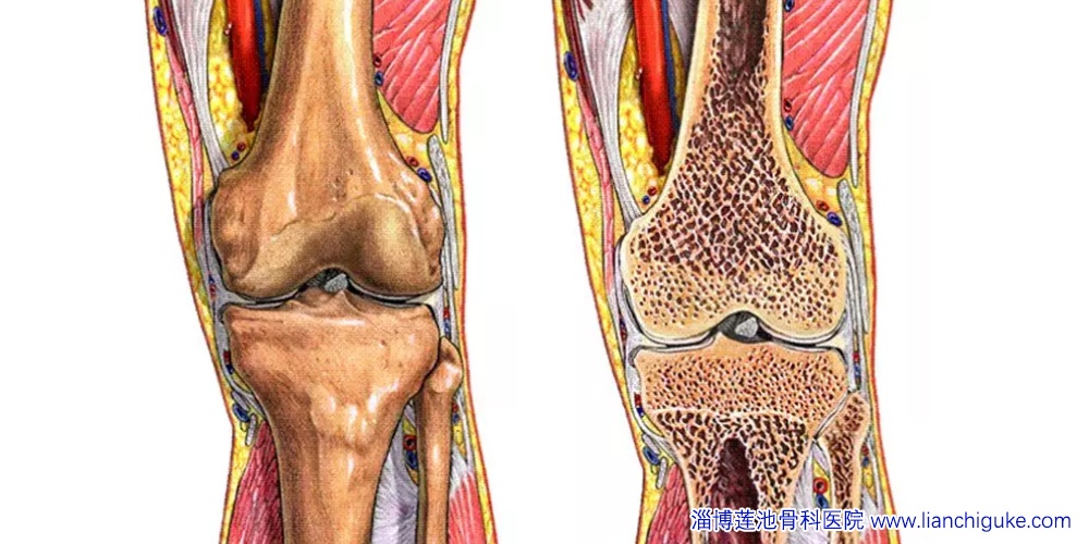 膝关节骨性关节炎的图示